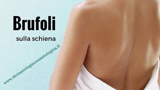 acne e brufoli sulla schiena