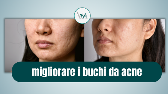 il trattamento più efficace per i buchi da acne